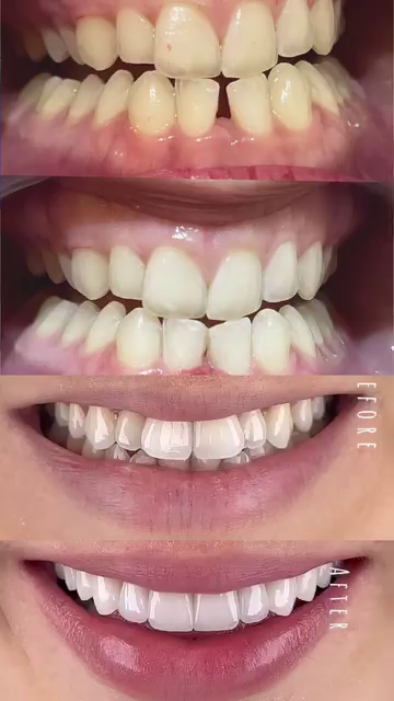 before after